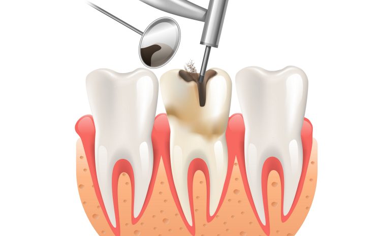 Root Canal Filling And Chipped Tooth Repair