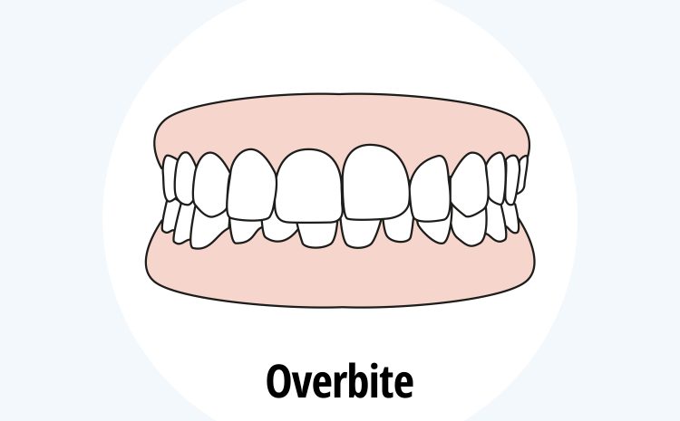  Overbite: Causes, Effects, and Treatment Options