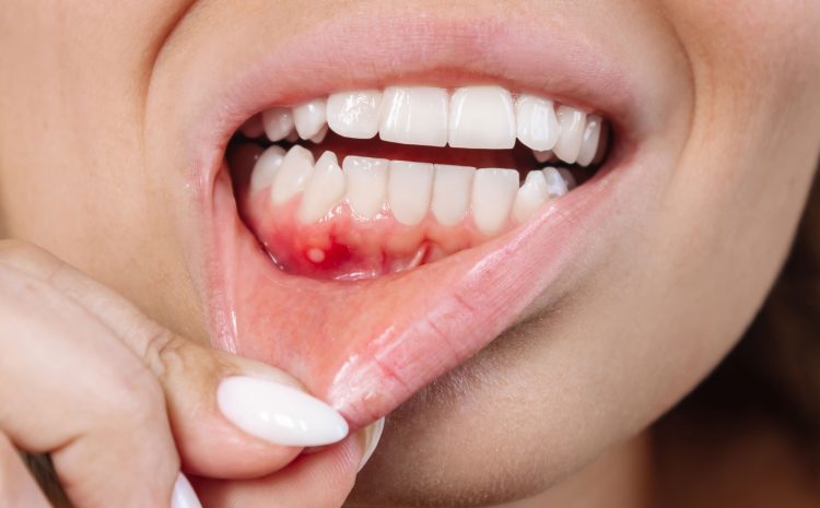  Abscess in the Mouth: Diagnosis, and Treatment